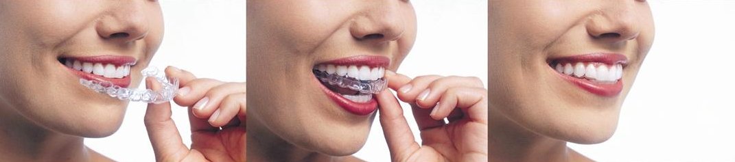 invisalign-dentists-chalfont-pa-ottsville