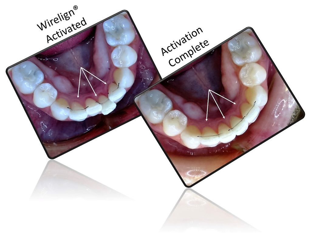 wirelign-invilible-orthodontic-better-than-invisalign